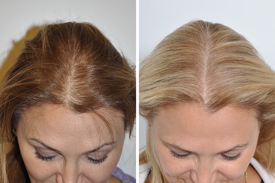 Hair Transplant Istanbul: Step-by-Step Journey to New Confidence